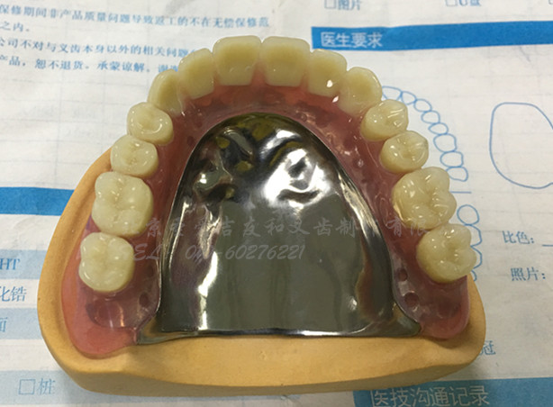 纯钛支架 ,请各位老师点评指导 - 北京圣爱吉友和义齿