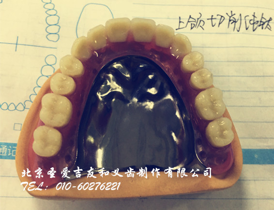 纯钛支架 ,请各位老师点评指导 - 北京圣爱吉友和义齿